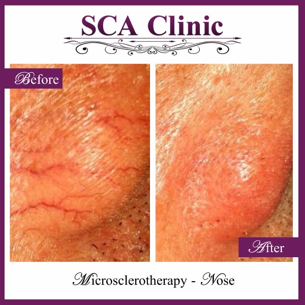 Microsclerotherapy - Nose